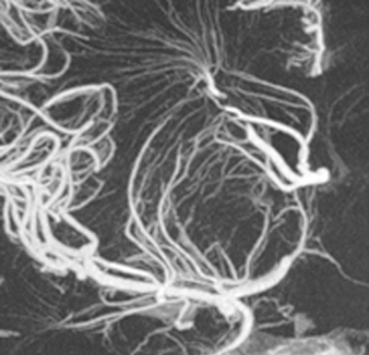 脳血管 Vaso CT