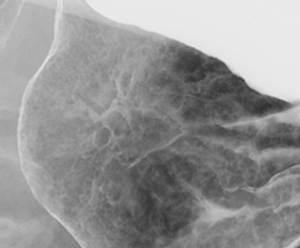 バリウム検査による早期胃がんX線写真